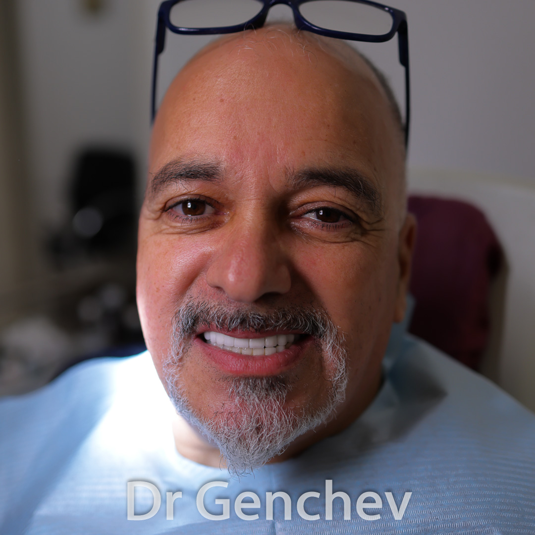 Patient of Dr Genchev after basal dental implants 