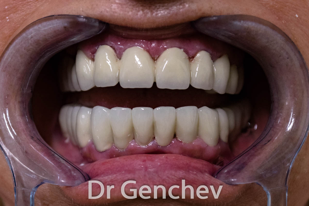 metal-ceramic metal ceramic dental crowns on basal implants