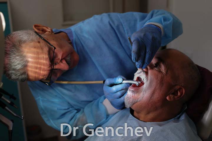 Dr Genchev fixing a basal dental implant