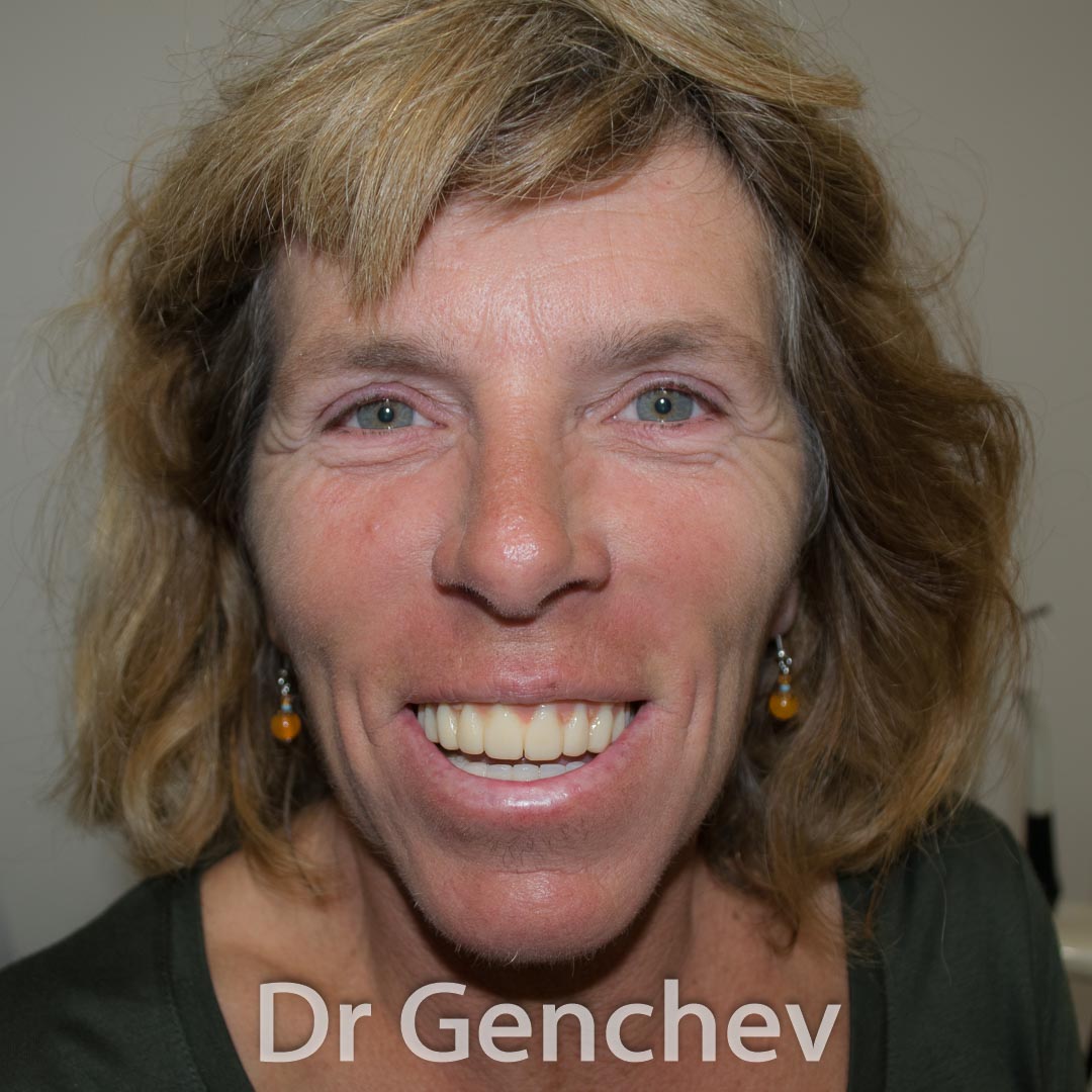 patient after basal dental implants