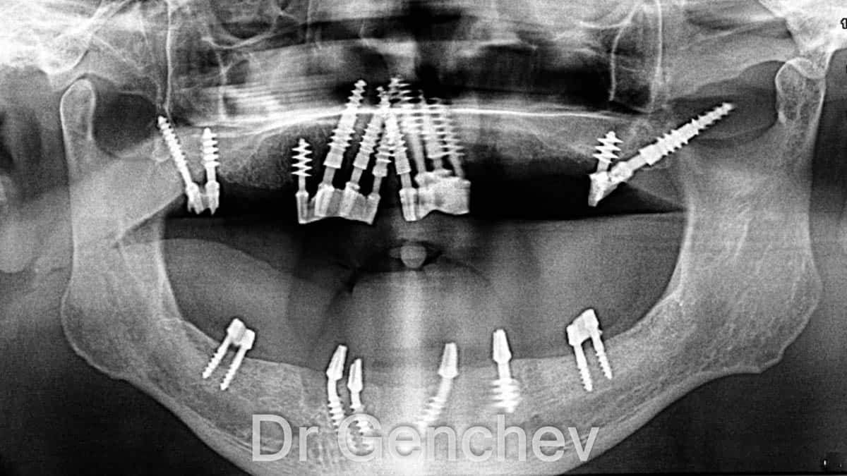 All-on-6 fallido salvado con implantes basales
