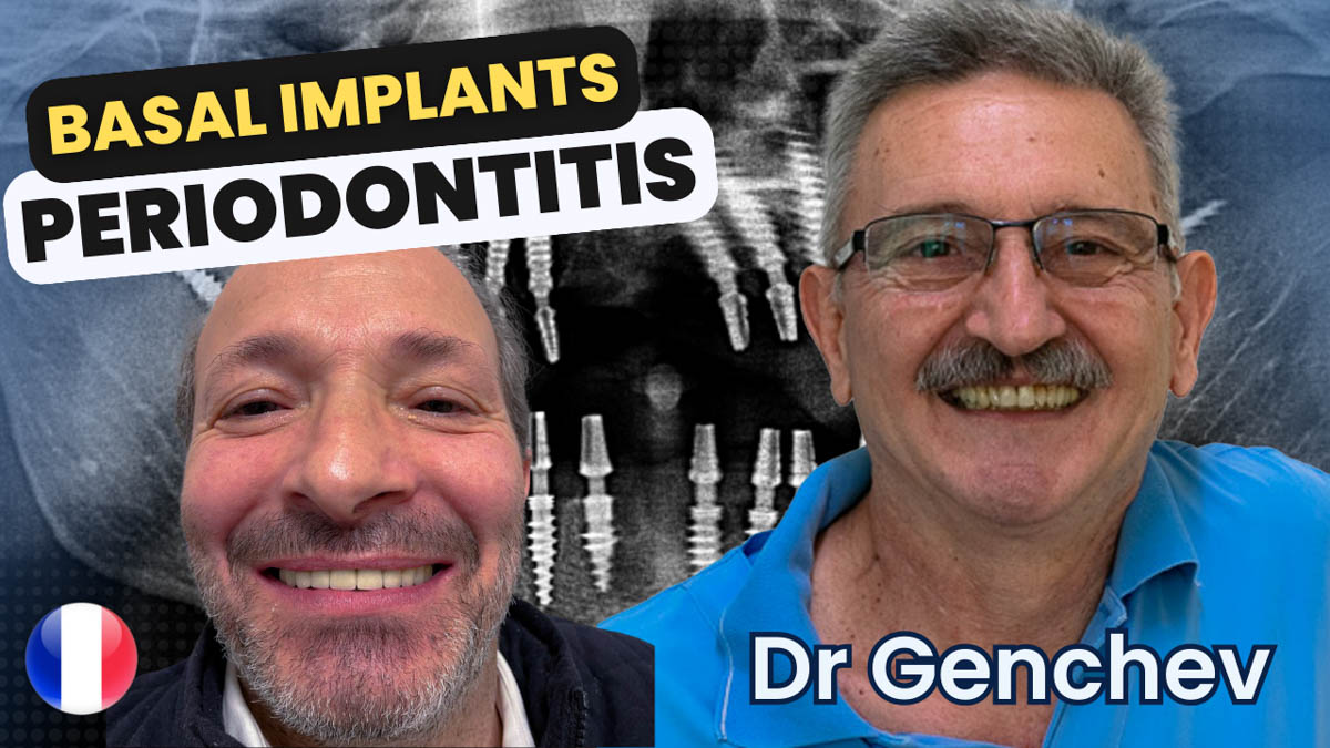 Implantes basales para la periodontitis